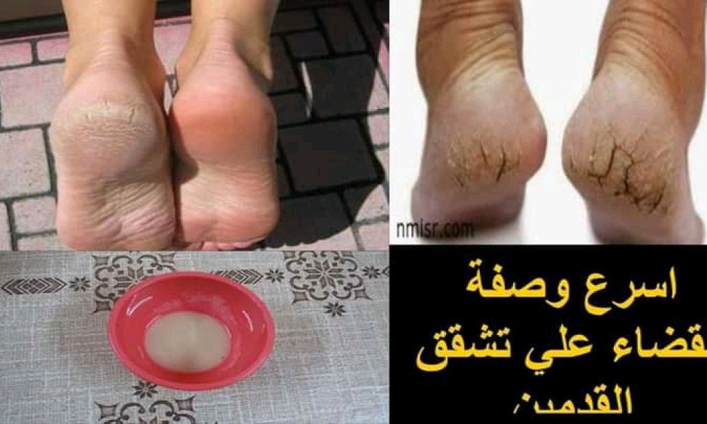 أسرع وصفه لعلاج تشققات القدمين