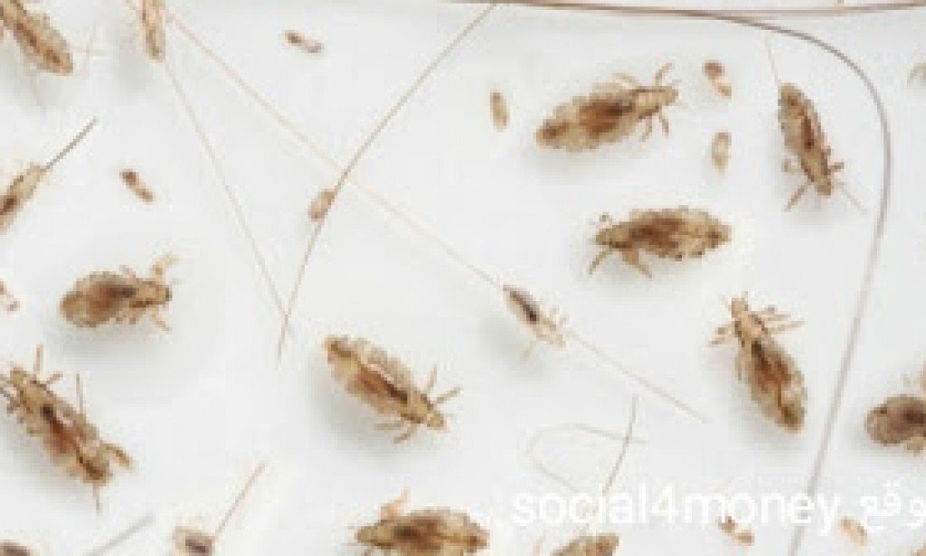 القمل واعراضه وكيفية علاجه