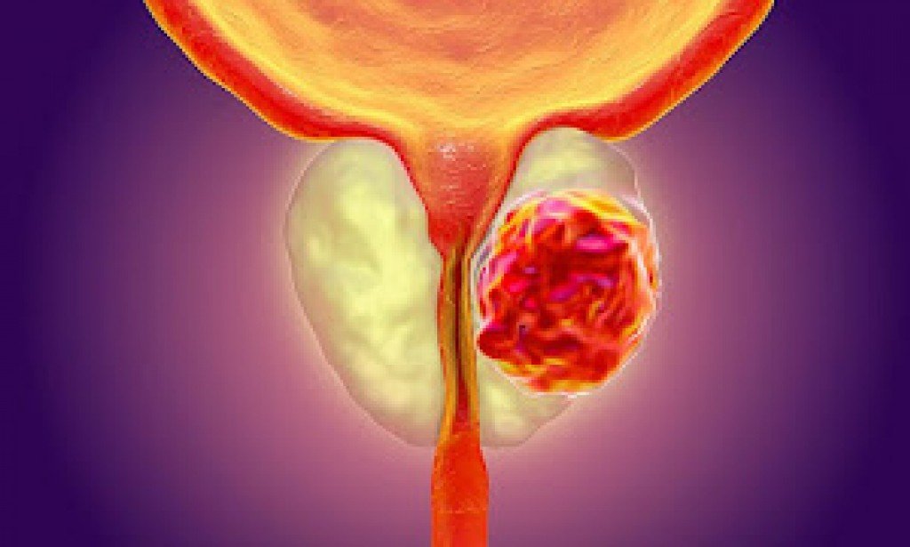 سرطان البروستاتا (Prostatic Cancer) الاسباب والعلاج