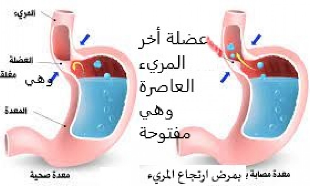 فسيولوجيا ارتجاع المريء | عومل وأسباب.. وقاية وعلاج!