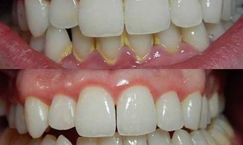 تنظيف جير الأسنان بالطرق المنزلية