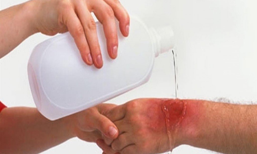 طرق سهلة لعلاج الحروق بالمنزل..