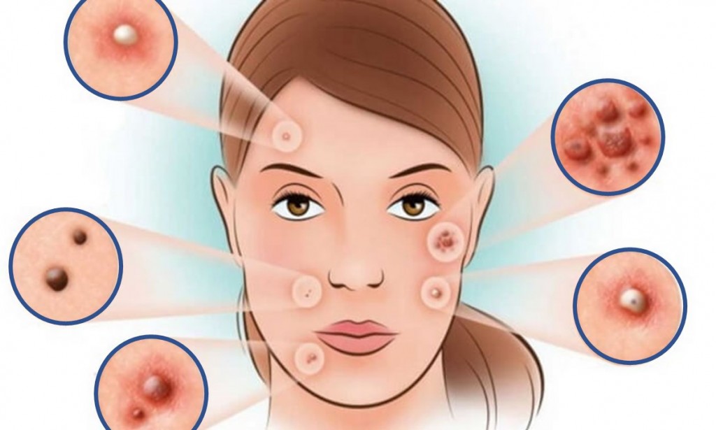 اسباب وعلاج الروؤس السوداء بالوجه