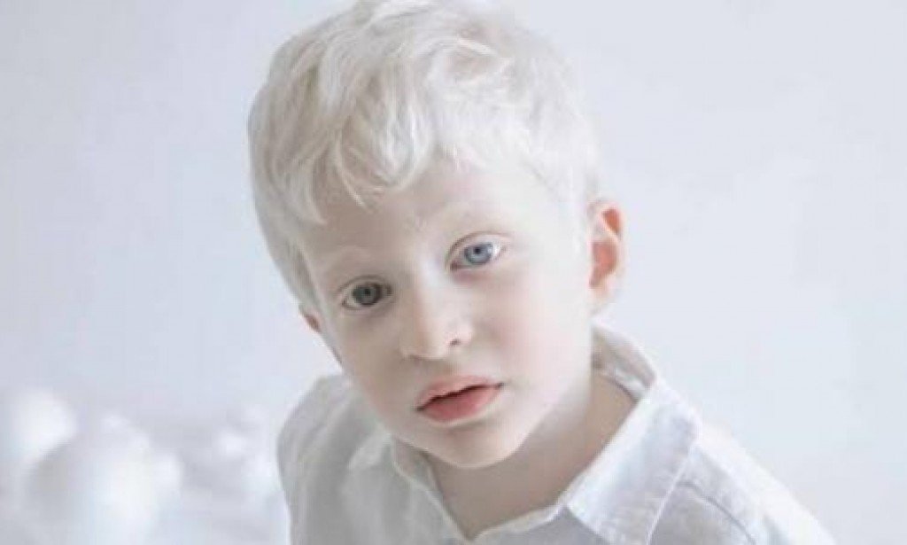 أسباب وأعراض مرض المهق وطرق الوقاية منه