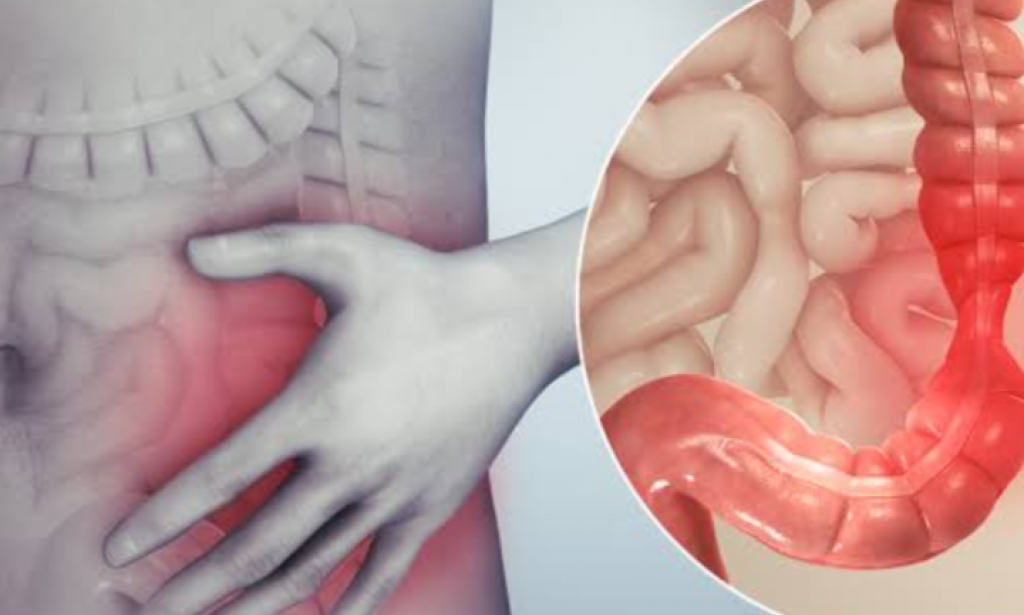 التخلص من مرض القولون العصبي في 3 دقائق