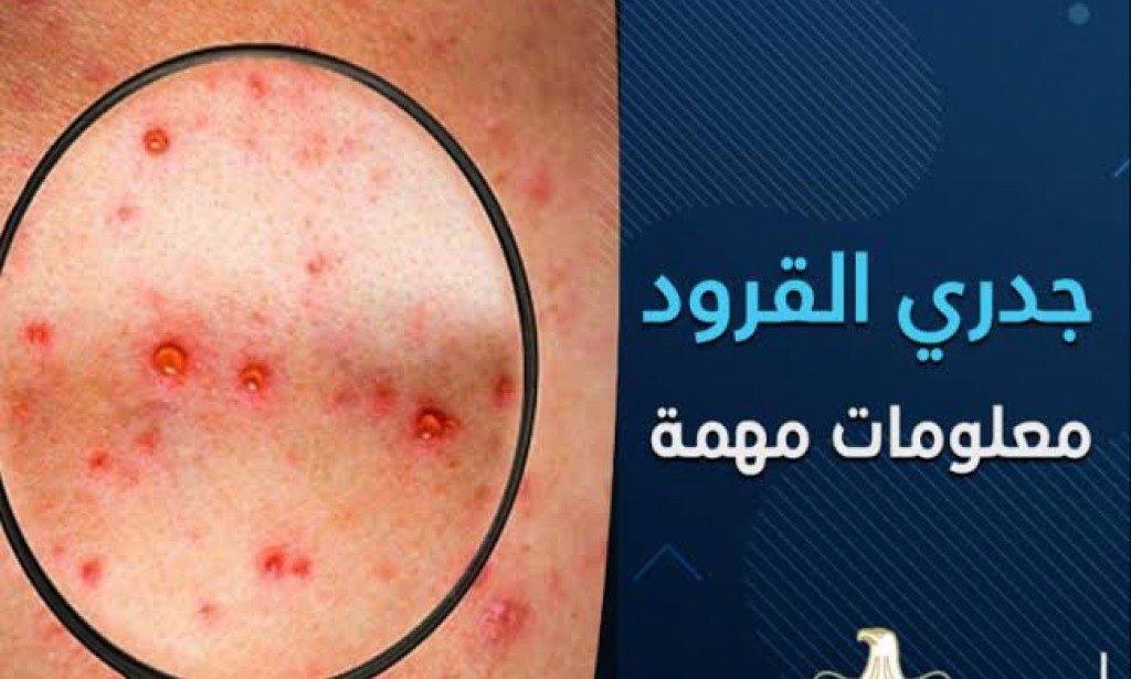 معلومات هامة حول مرض جدري القرود