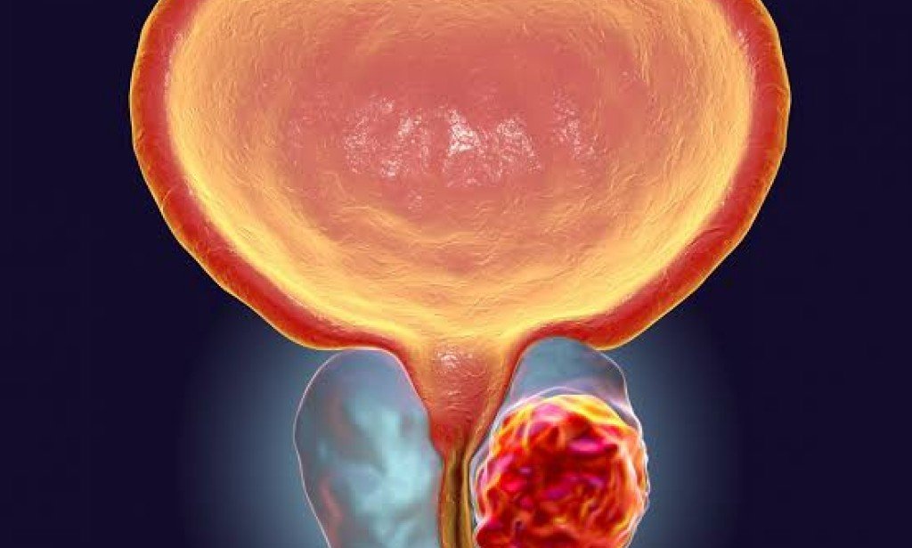سرطان البروستاتا .. عند ظهور 10 أعراض يجب مراجعة الطبيب على الفور