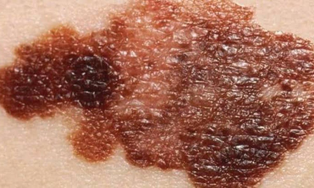 ما هو سرطان الجلد واعراضه والوقايه منه فى وقت مبكر؟