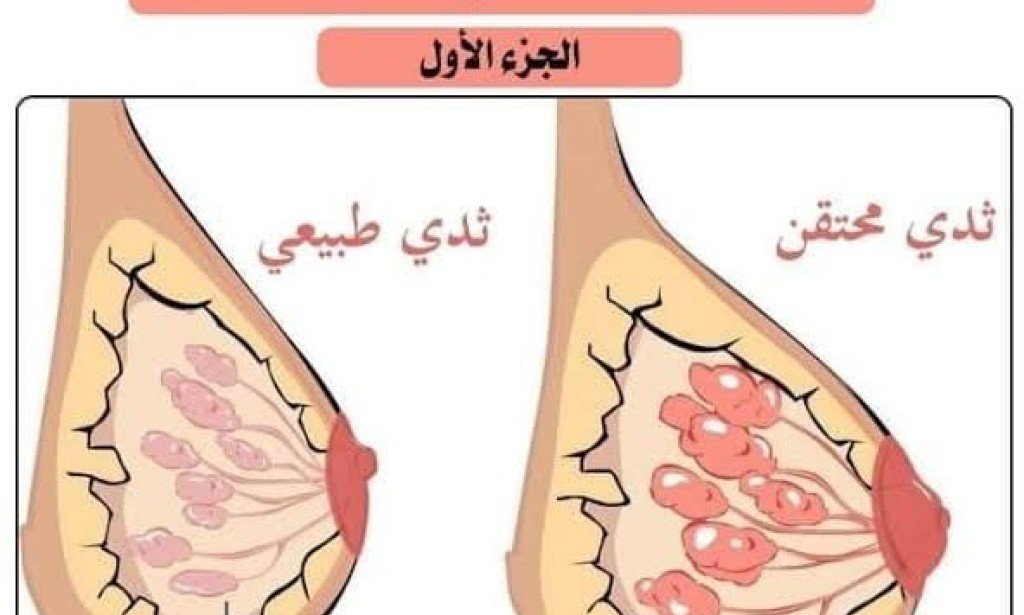علاج احتقان الثدي بسبب عدم رضاعة الطفل وصفات غذائية خاصة للحصول على ثدي سليم بدون التهاب