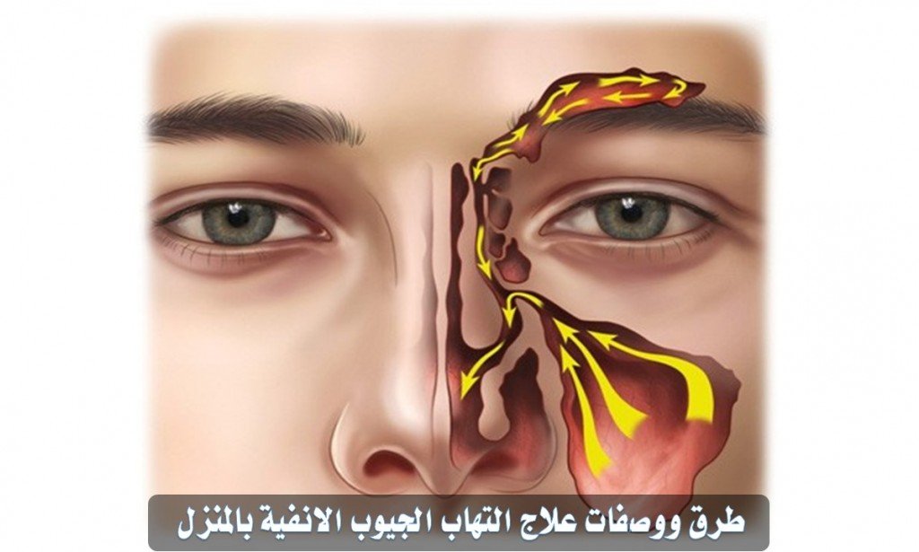 طرق علاج التهاب الجيوب الانفية بالمنزل