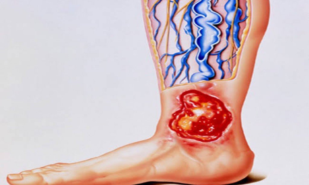 القرحة الوريدية المزمنة