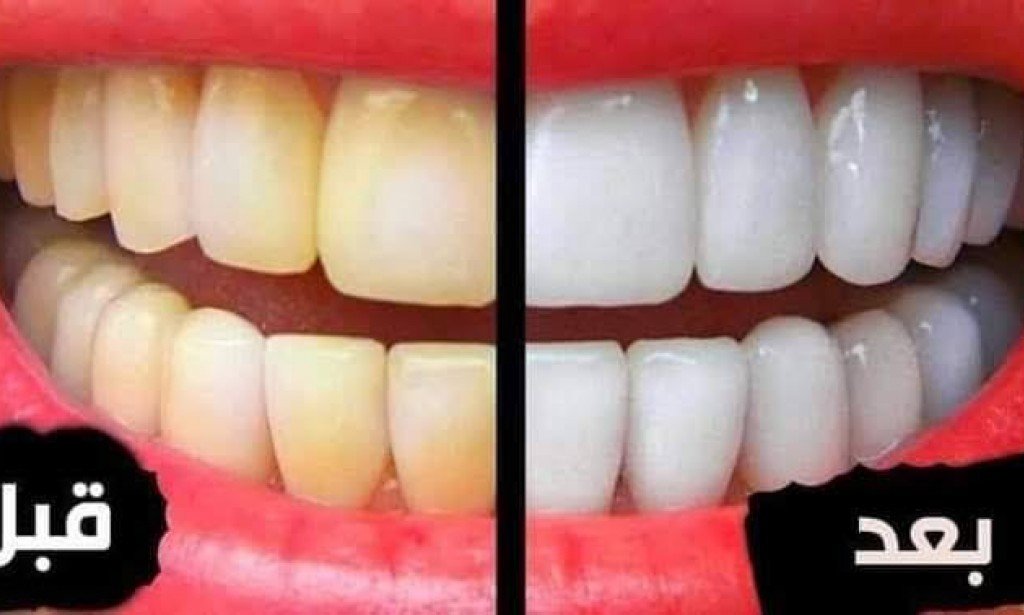 وصفات طبيعيه للتخلص من اصفرار الاسنان