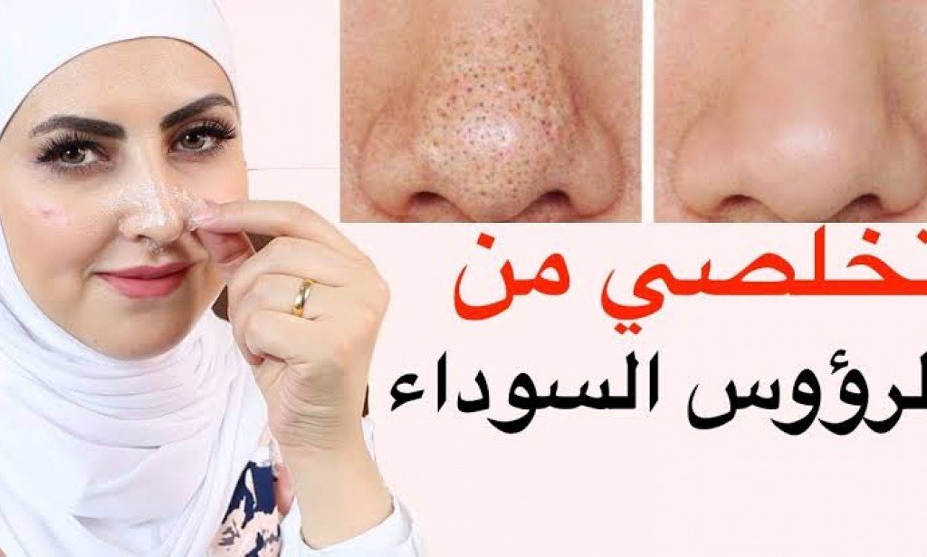 7 طرق تساعدك على التخلص من الرؤوس السوداء في الوجه