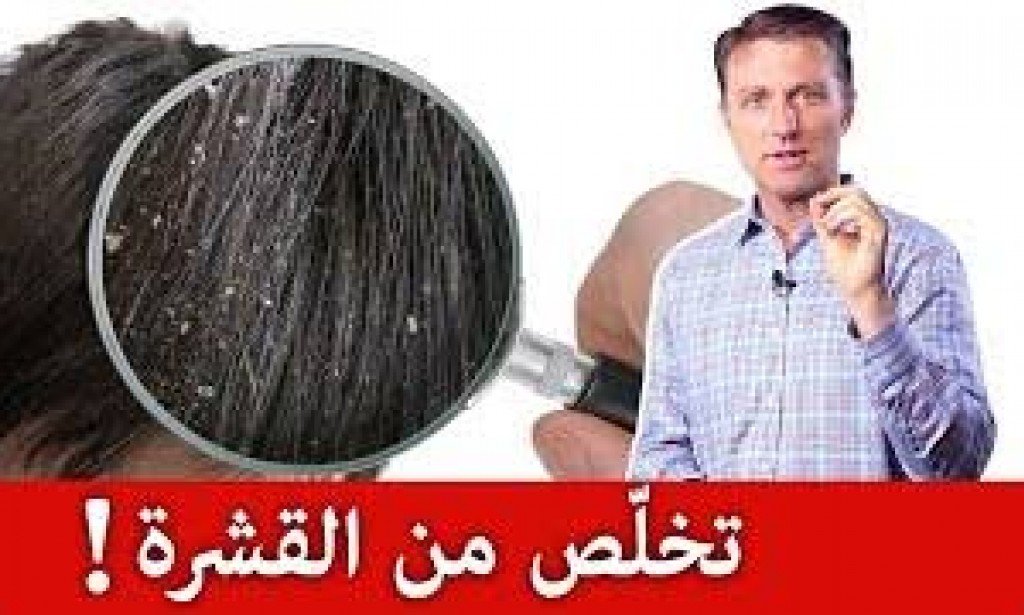 ﻿كيفية التخلص من قشرة الشعر بشكل نهائي؟