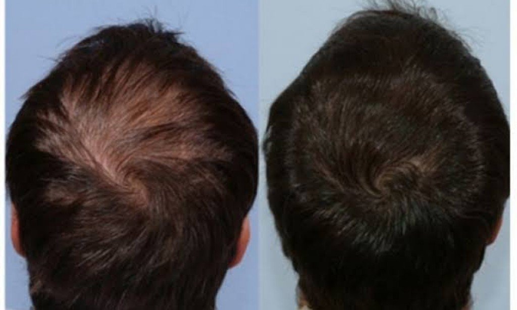 اسباب وعلاج الصلع ..10 وصفات طبيعية تخلصك من الصلع نهائيًا