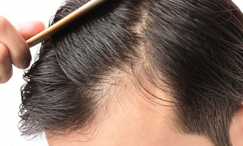 تفسير حلم سقوط الشعر للرجل المتزوج