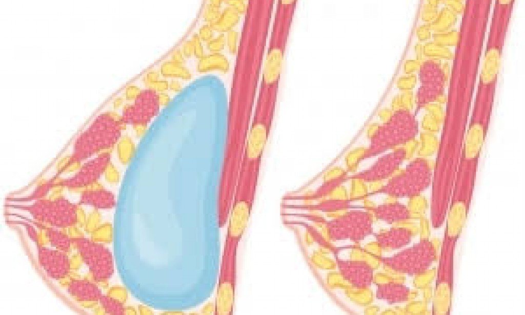 تجارب ناجحة لتكبير الثدي