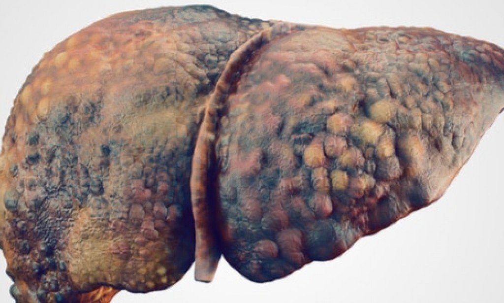 علامات موت مريض تليف الكبد