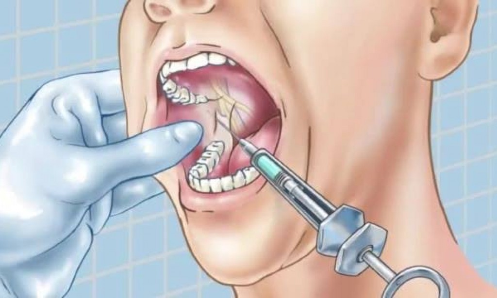 التخدير في طب الأسنان