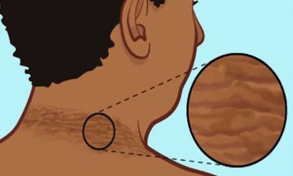 مقاومة الأنسولين وأسبابها وعلاجها