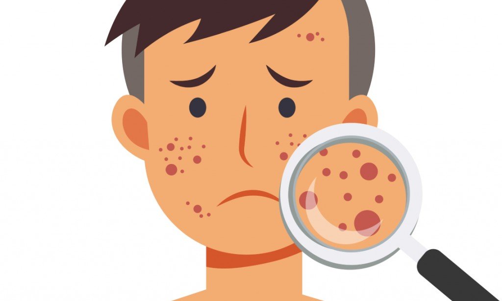 كيفية التخلص من حب الشباب وآثاره بشكل دائم!