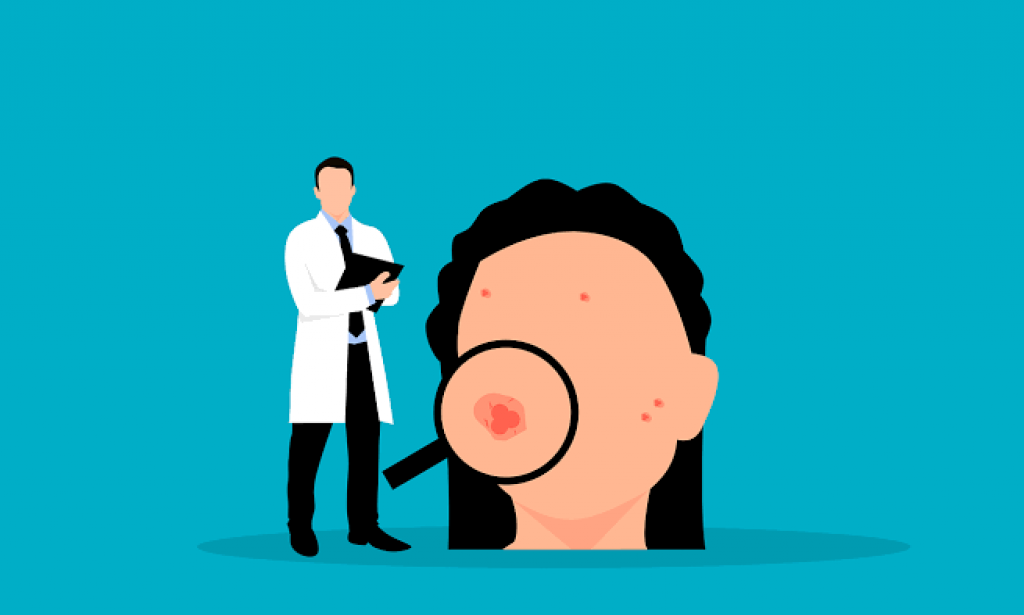 علاج حب الشباب الشائع عند البنات ومعرفة أسبابه