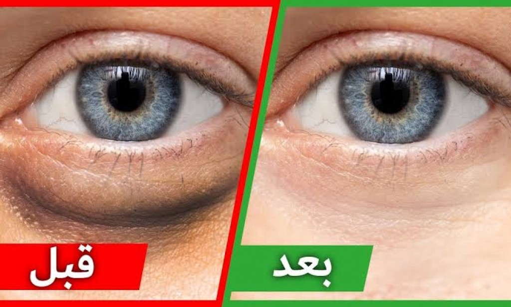 طرق التخلص من الهالات السوداء أسفل العين بشكل نهائي