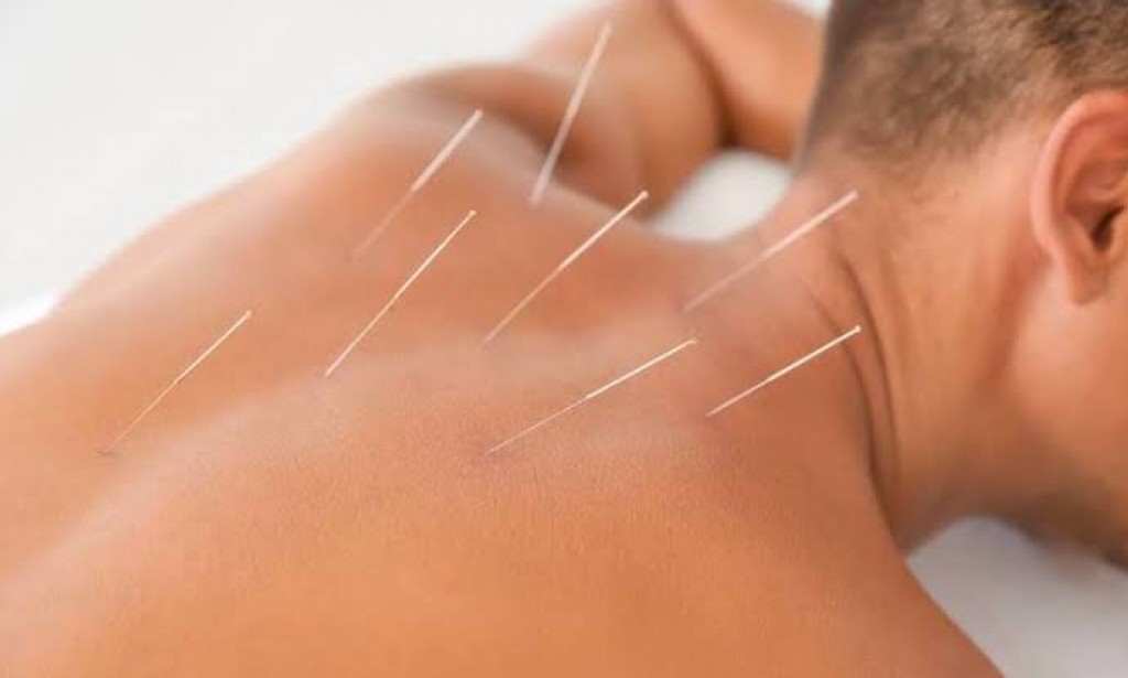 الوخز بالابر الصينية - ماهو و ماهي فوائده و مخاطره؟