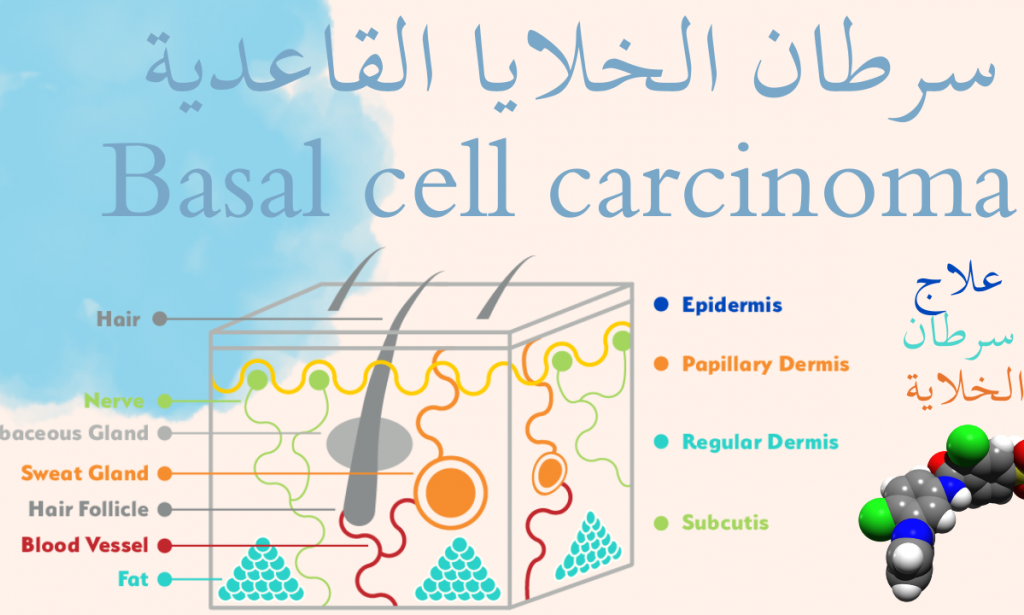 سرطان الخلايا القاعدية | علاج سرطان الخلايا القاعدية