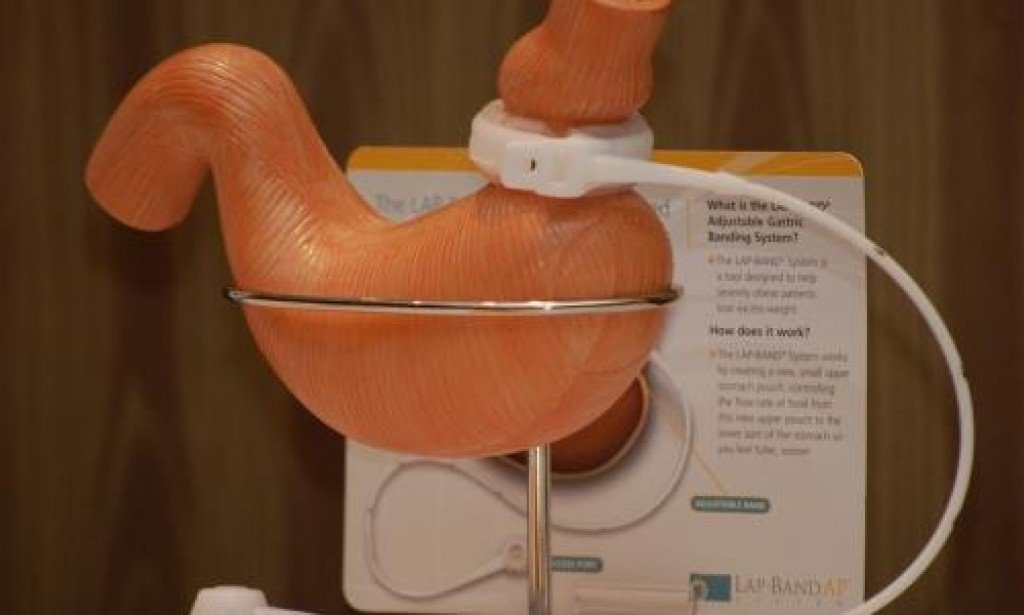 طرق تصغير المعدة