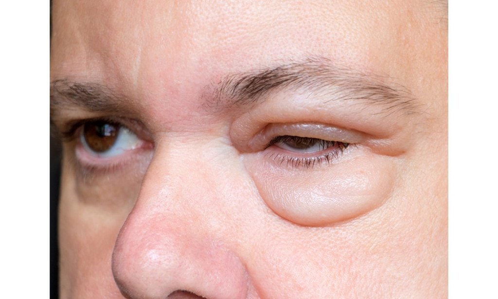 انتفاخ العين: 7 أسباب قد تكون وراءه